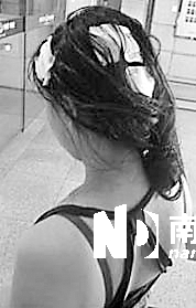 <p>    傷者頭部被砸出多個血洞。 通訊員杜亞軍南都記者徐文閣 攝</p>