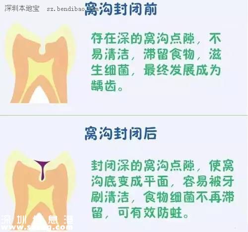 深圳(www.huhuzc.cn)二年級學生娃可免費做窩溝封閉 可預防齲齒哦