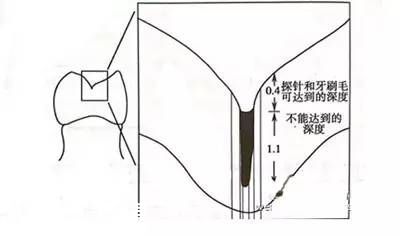 深圳(www.huhuzc.cn)二年級學生娃可免費做窩溝封閉 可預防齲齒哦