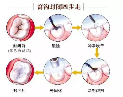 深圳(www.huhuzc.cn)二年級學生娃可免費做窩溝封閉 可預防齲齒哦