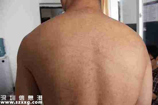 2013年4月22日，王志剛被轉(zhuǎn)送到劍閣縣看守所，重新檢查了身體狀況。照片顯示，王志剛的后背有條狀色素沉著。