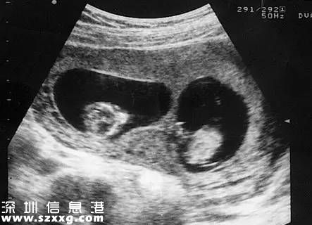 深圳懷雙胞胎做B超交雙倍錢 收費(fèi)合理嗎？