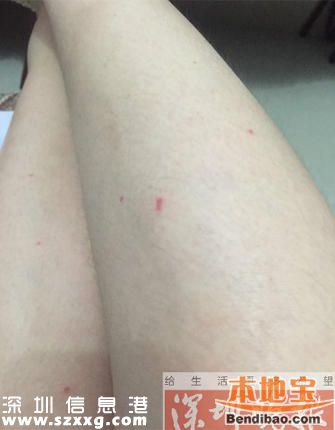 女子深圳住酒店半夜床上驚現(xiàn)十幾只蟲 身上又癢又痛